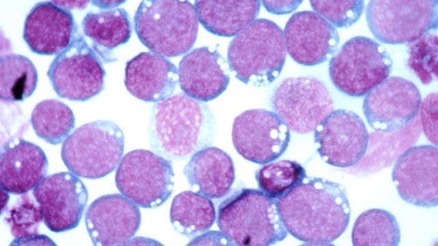 Epstein-Barr virus (EBV) stained with Hematoxylin and eosin (HE) 