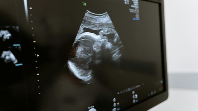 Monitor showing an ultrasound of an unborn baby. 