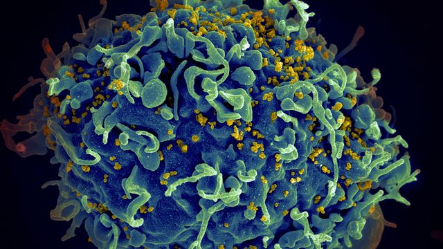 HIV, the AIDS virus (yellow), infecting a human cell. 