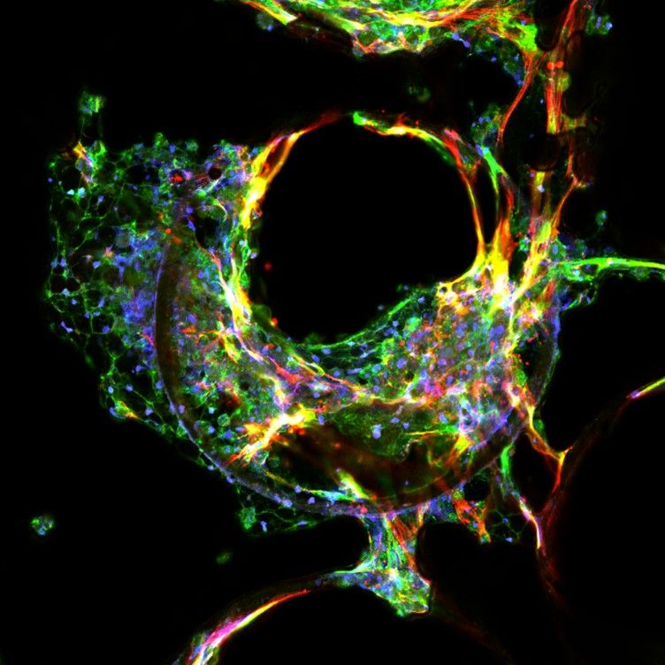 A confocal image of MASH liver tissue generated using MPS. 