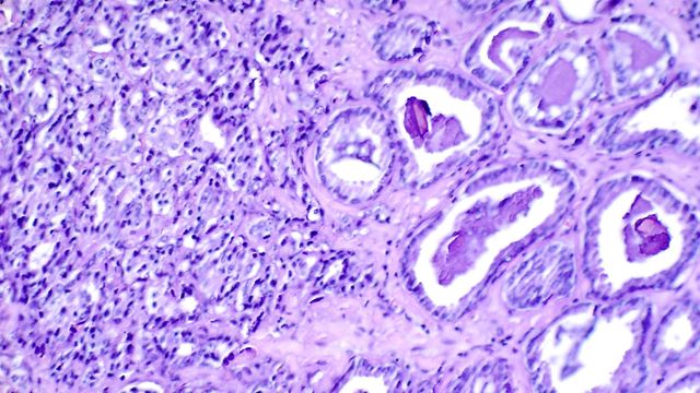 A purple-stained microscope slide showing two grades of prostate cancer. 