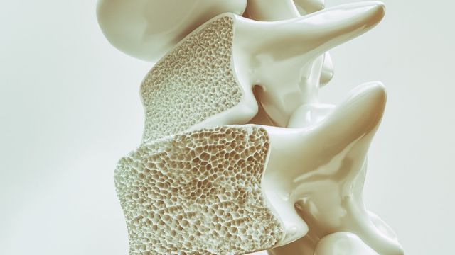 Model of spinal vertebrae with osteoporosis.  